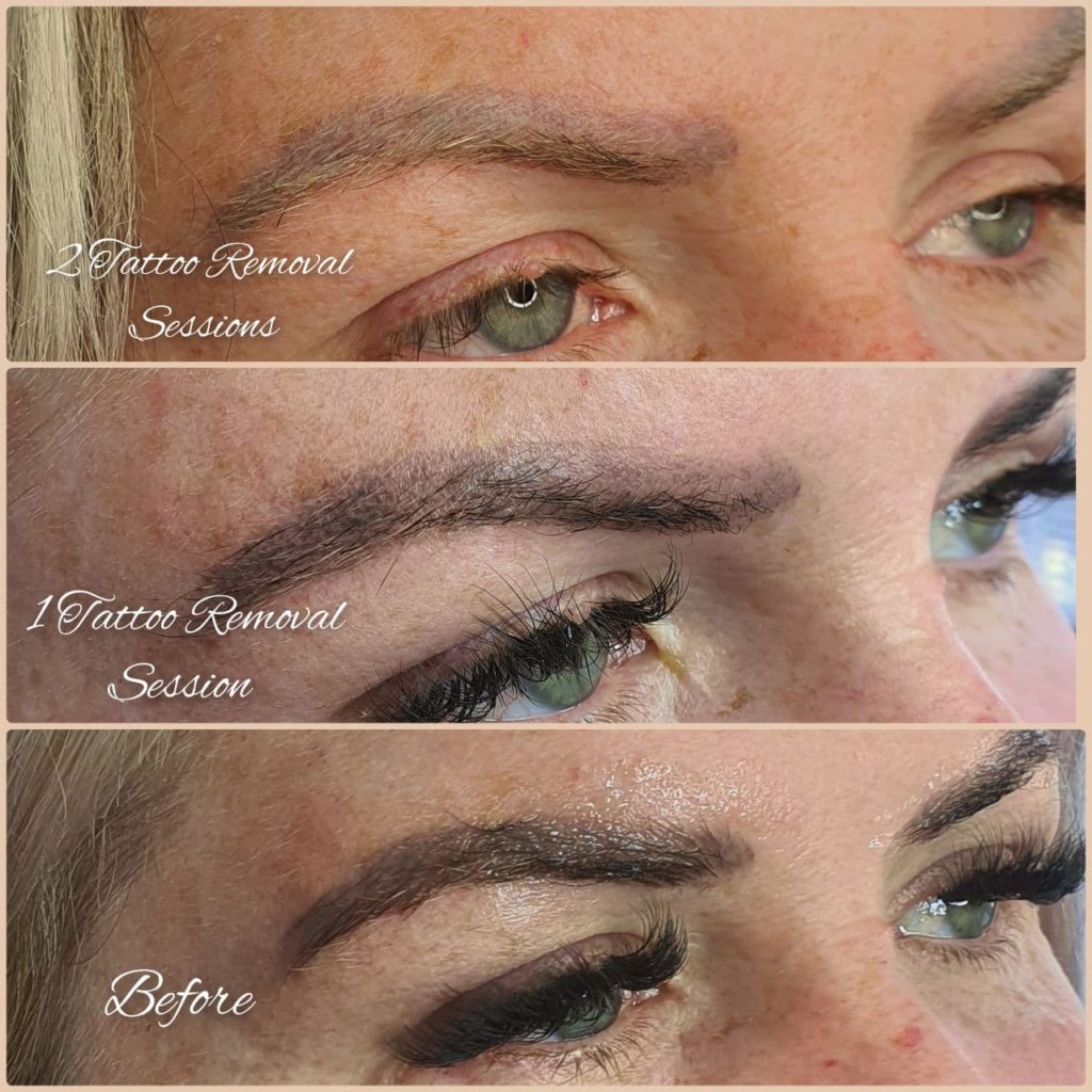 Eyebrow Tattoo Removal using Saline solution  YouTube