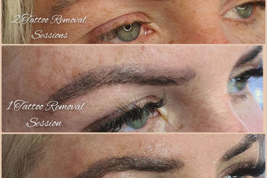 eyebrow tattoo removal