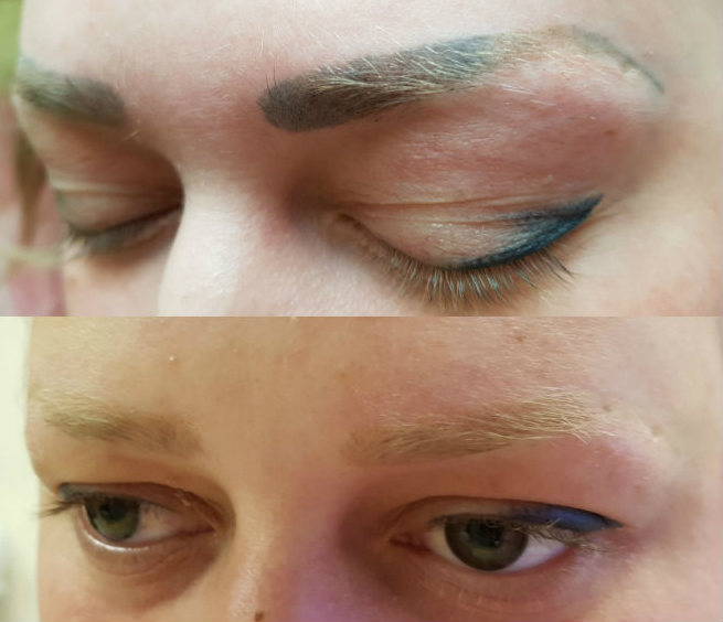 eyebrow tattoo removal