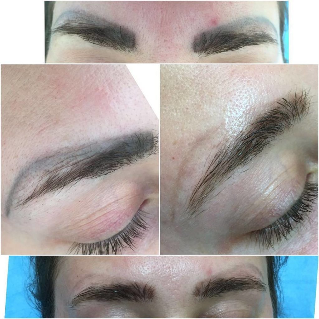 eyebrow tattoo removal